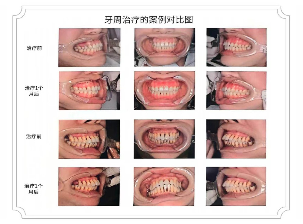 牙周治疗案例