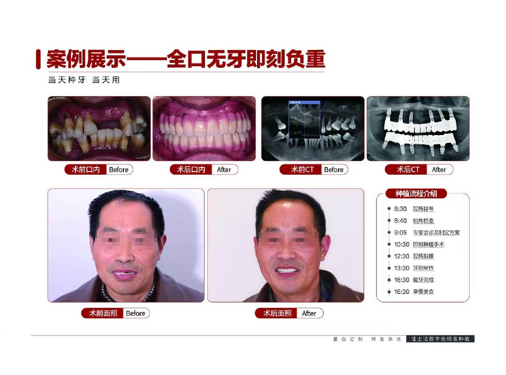 全口无牙即刻负重